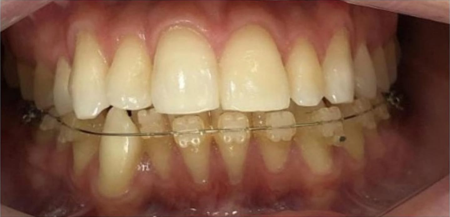 Dra. Amanda Viecilli – Ortodontia e Estética Dental em Canoas Sorriso transformado com Ortodontia e Lentes de Resina pela Dra. Amanda Viecilli em Canoas
