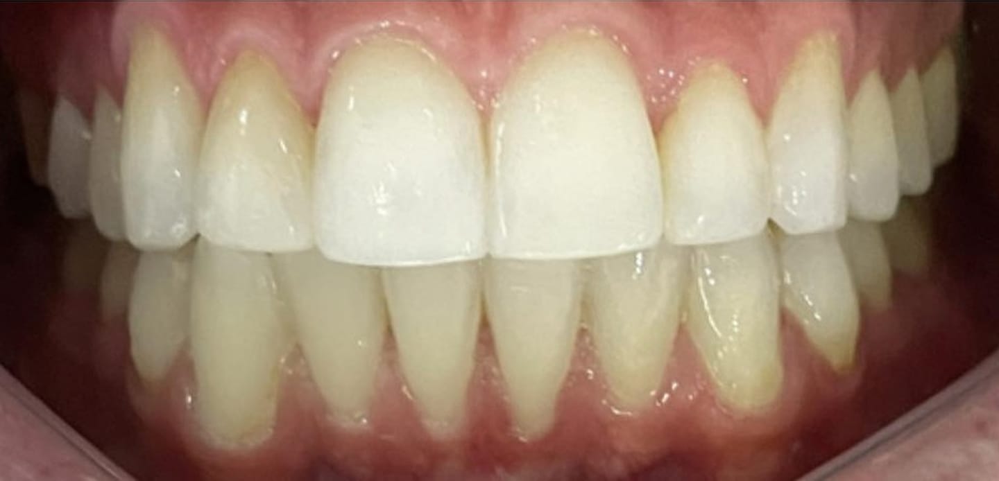 2depois–invisalign 2depois--invisalign