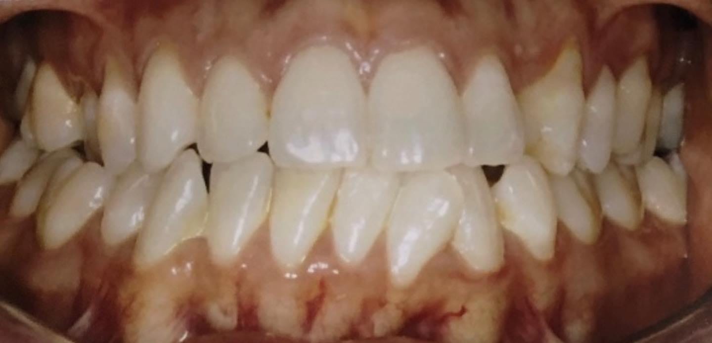 3antes–invisalign 3antes--invisalign