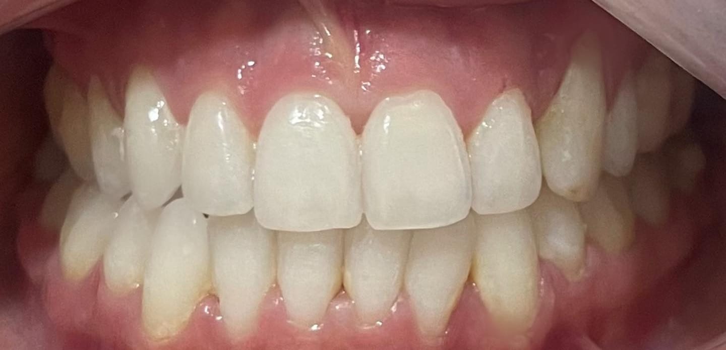 3depois–invisalign 3depois--invisalign