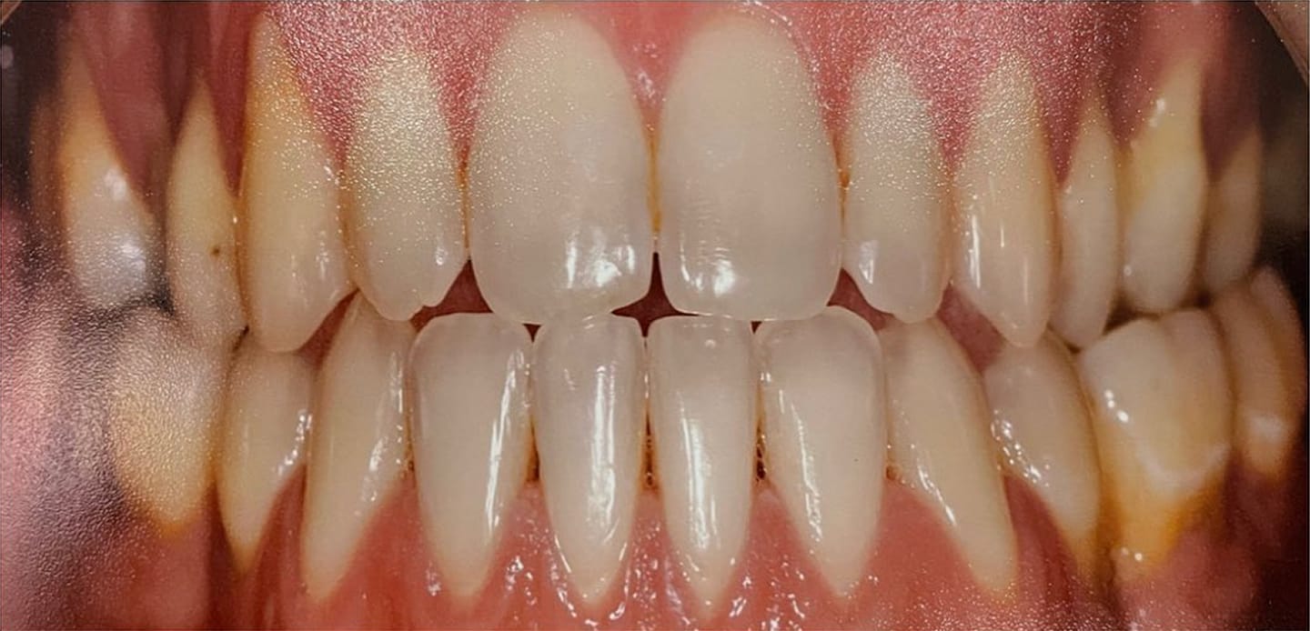 4antes–invisalign 4antes--invisalign