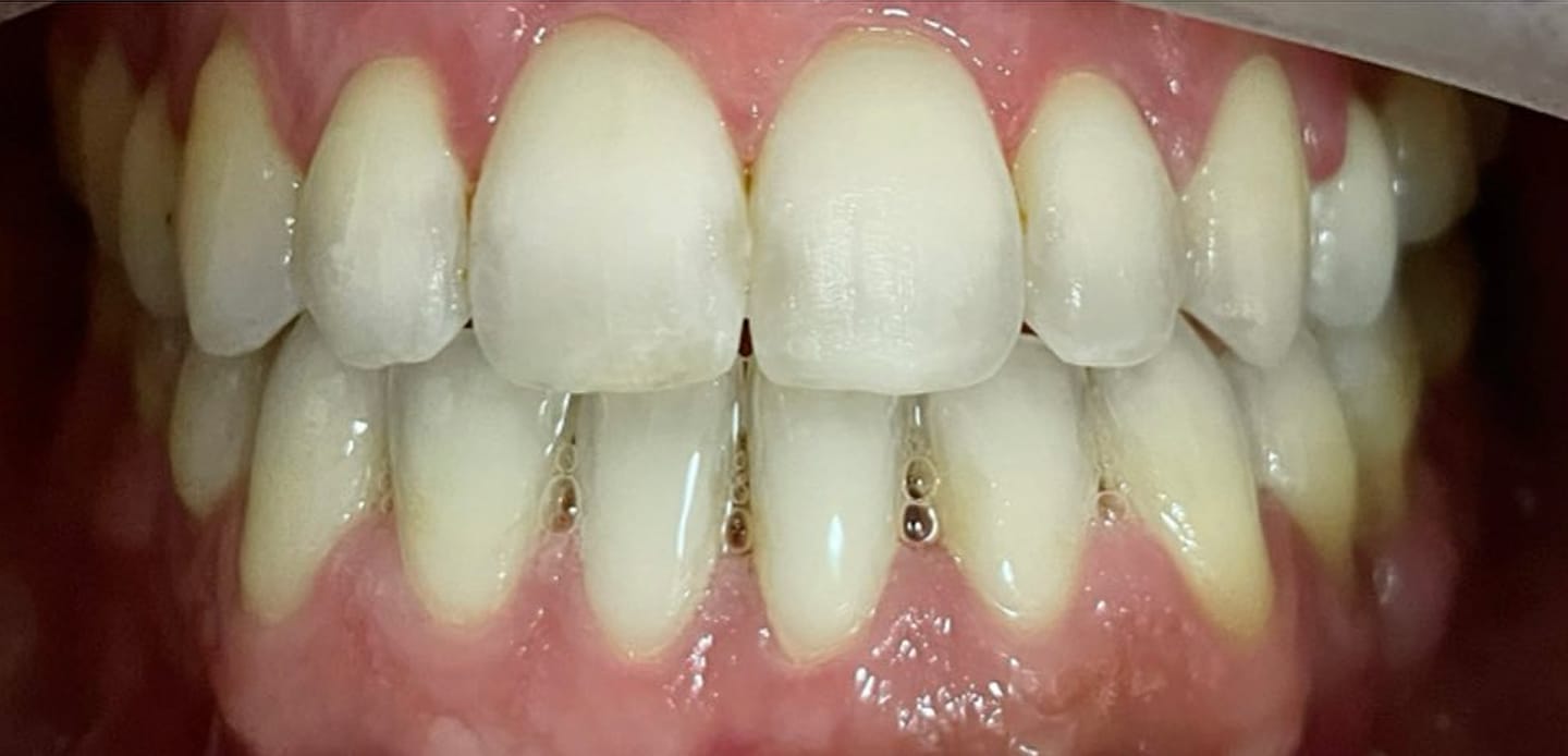 4depois–invisalign 4depois--invisalign