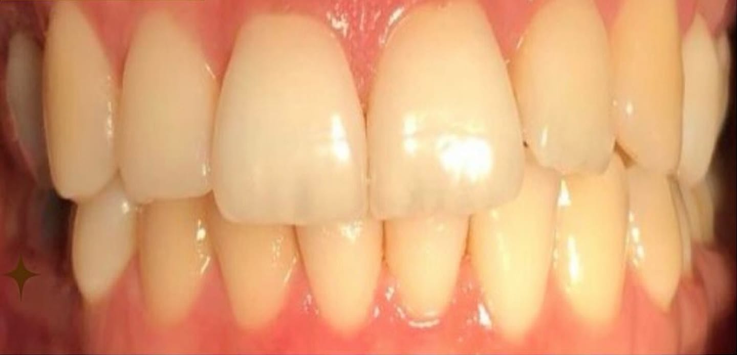 5antes–invisalign 5antes--invisalign