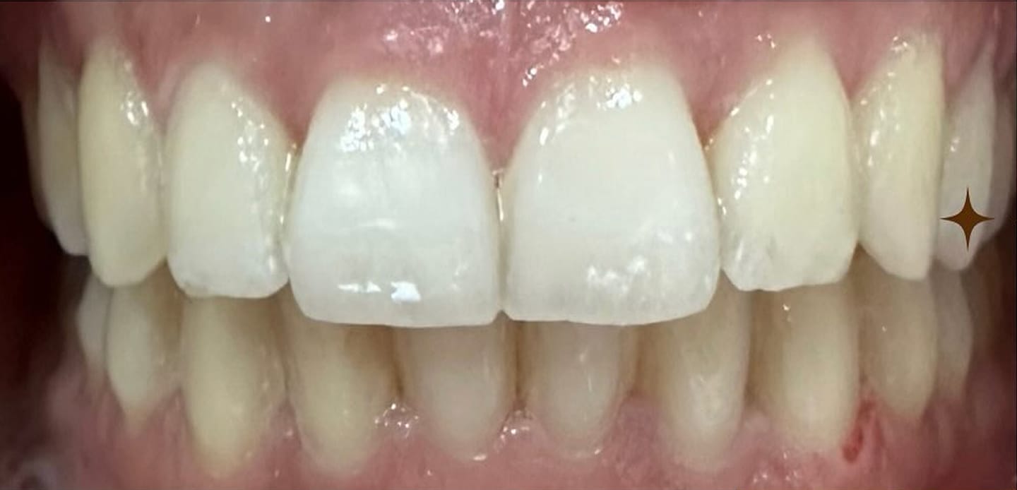 5depois–invisalign 5depois--invisalign