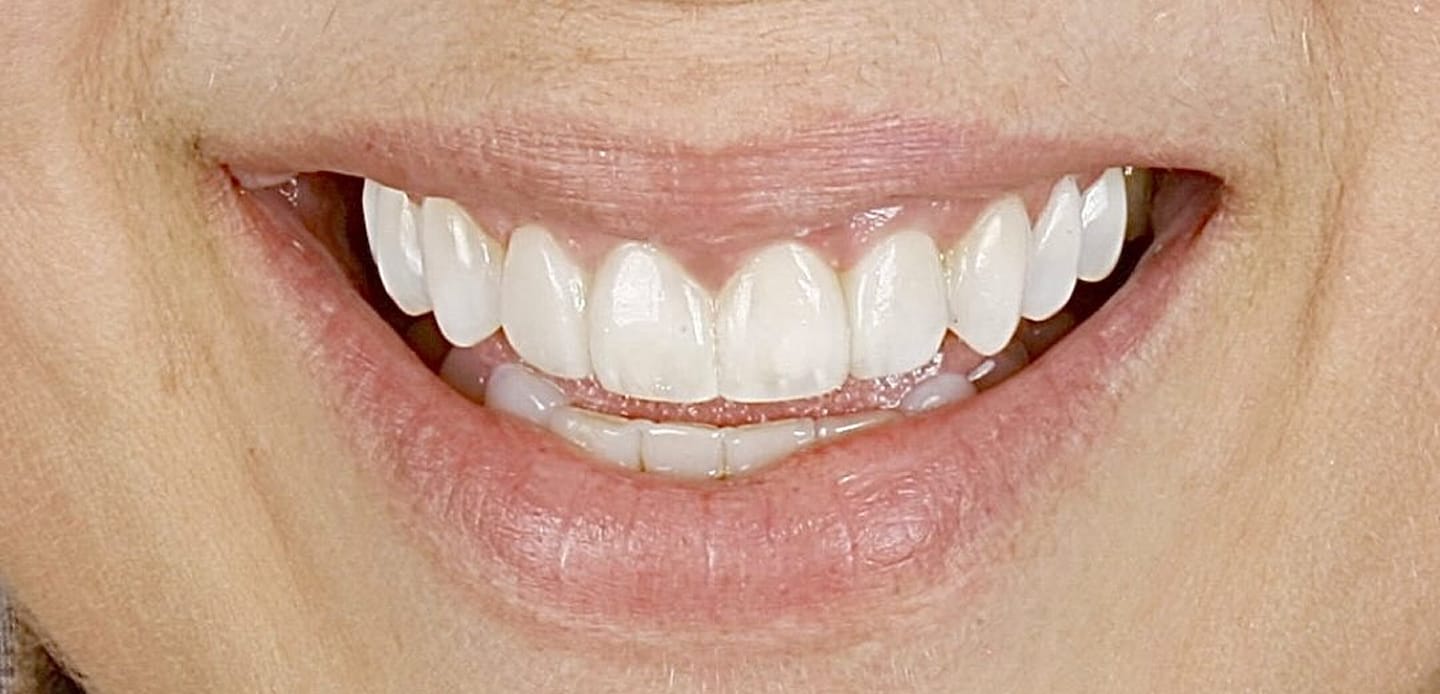 antes-ddepois3-facetas em resina composta antes-ddepois3-facetas em resina composta