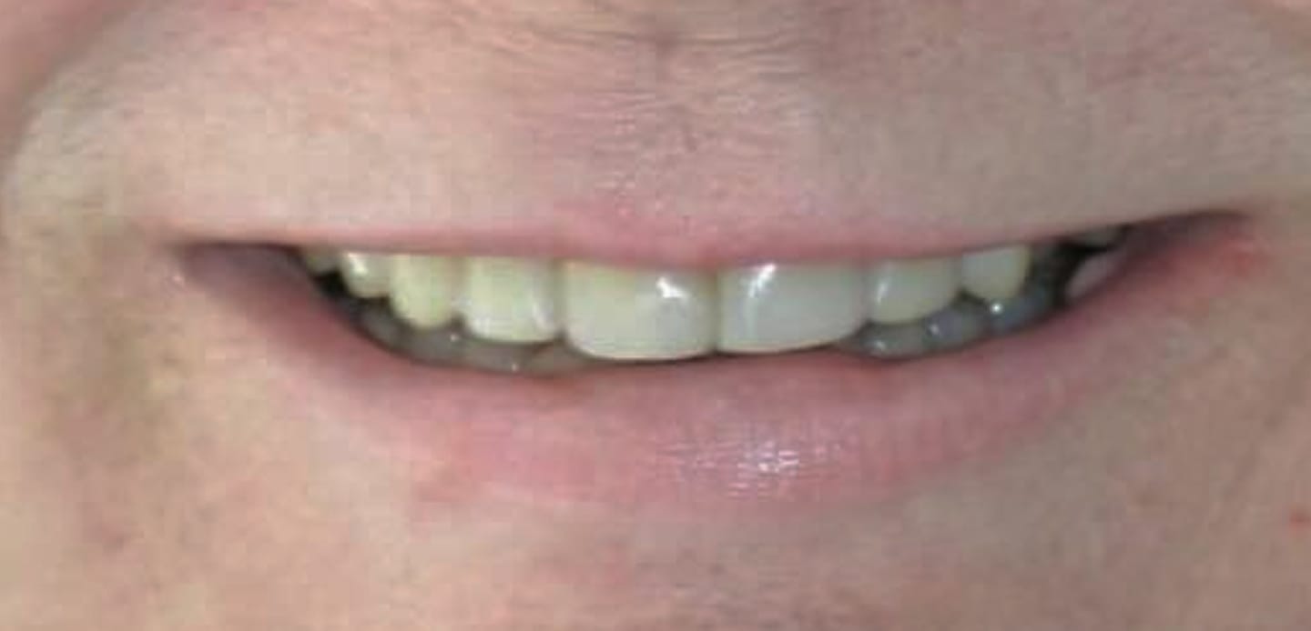 antes-depois2-Lentes de resina-composta antes-depois2-Lentes de resina-composta