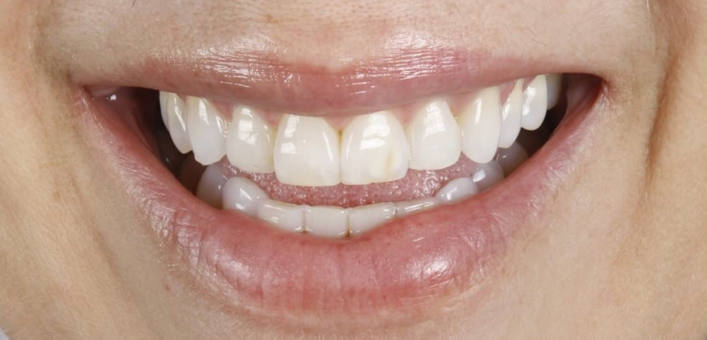 antes-depois3-facetas em resina composta antes-depois3-facetas em resina composta
