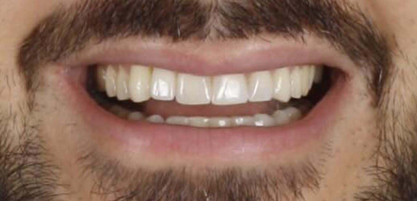 antes-depois5- facetas de resina composta antes-depois5- facetas de resina composta