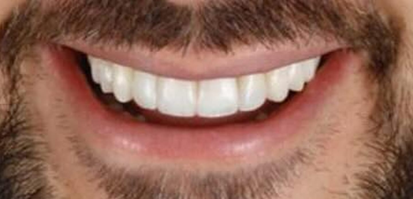 antes-depoiss5- facetas de resina composta antes-depoiss5- facetas de resina composta