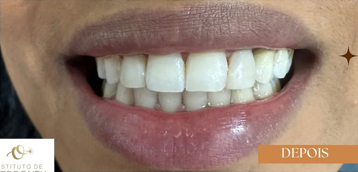 antes-depoiss8- transformacoes-com-resina-composta antes-depoiss8- transformacoes-com-resina-composta
