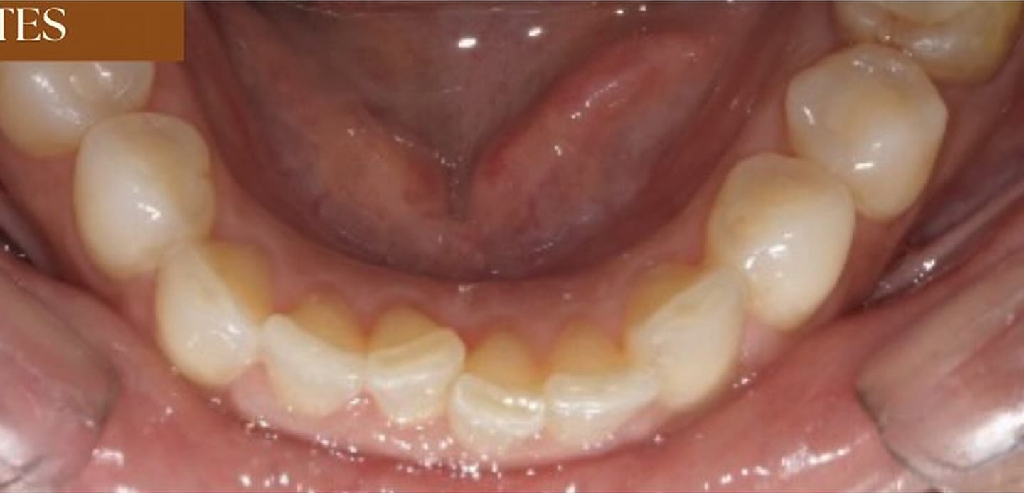 antes11 antes11