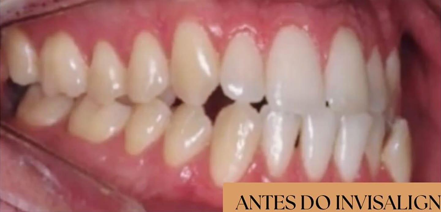 antes22 antes22