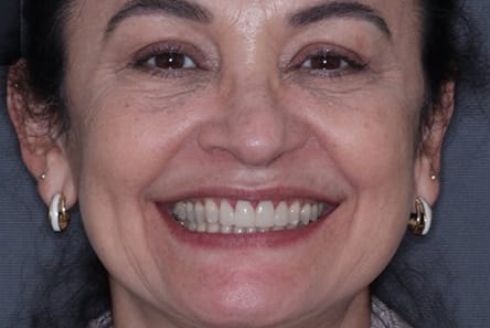 transformacao-invisalign-e-resina